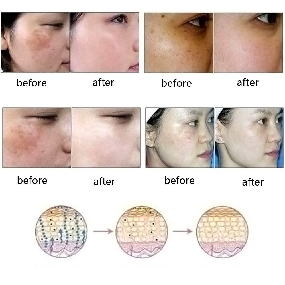 Stretch Marks Removal