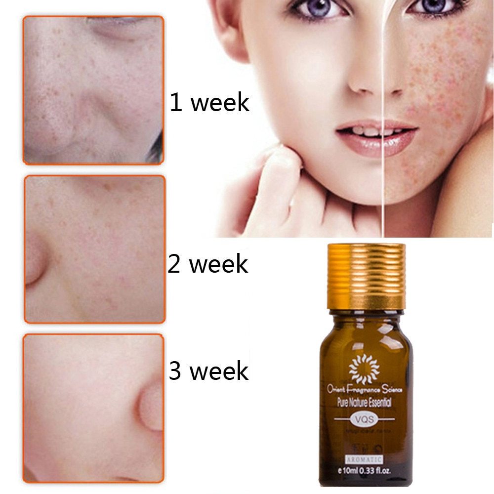Stretch Marks Removal